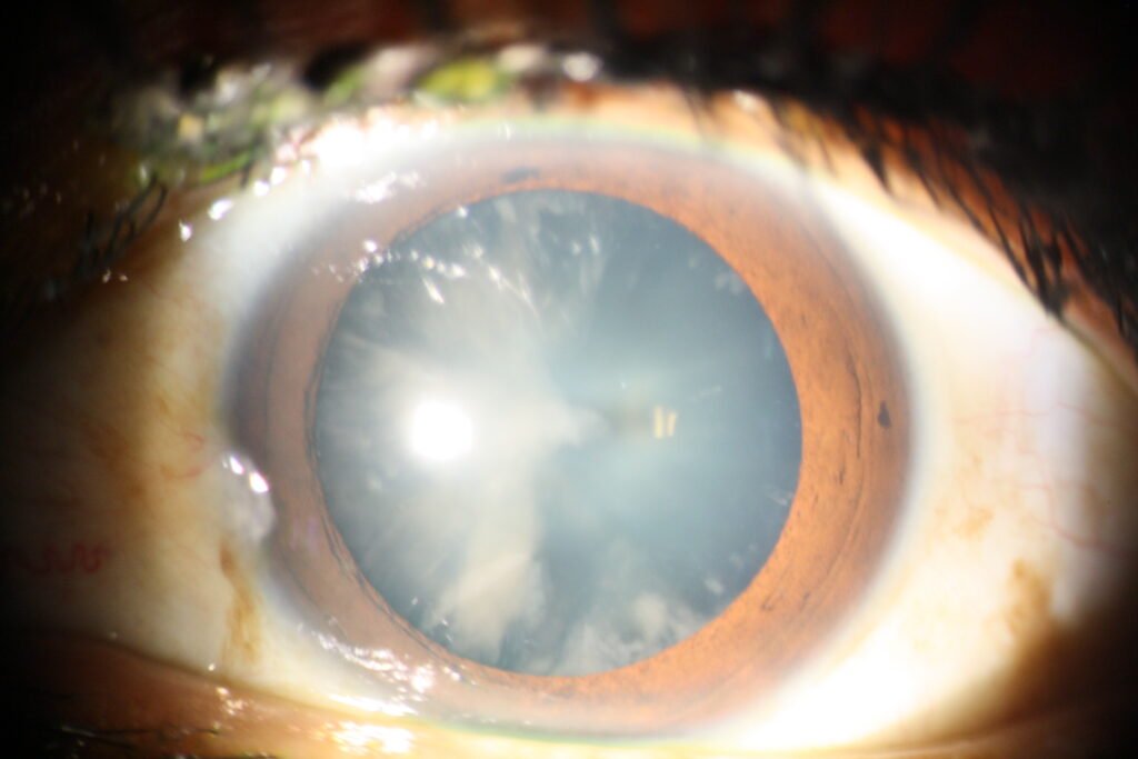 catarata cortical 5